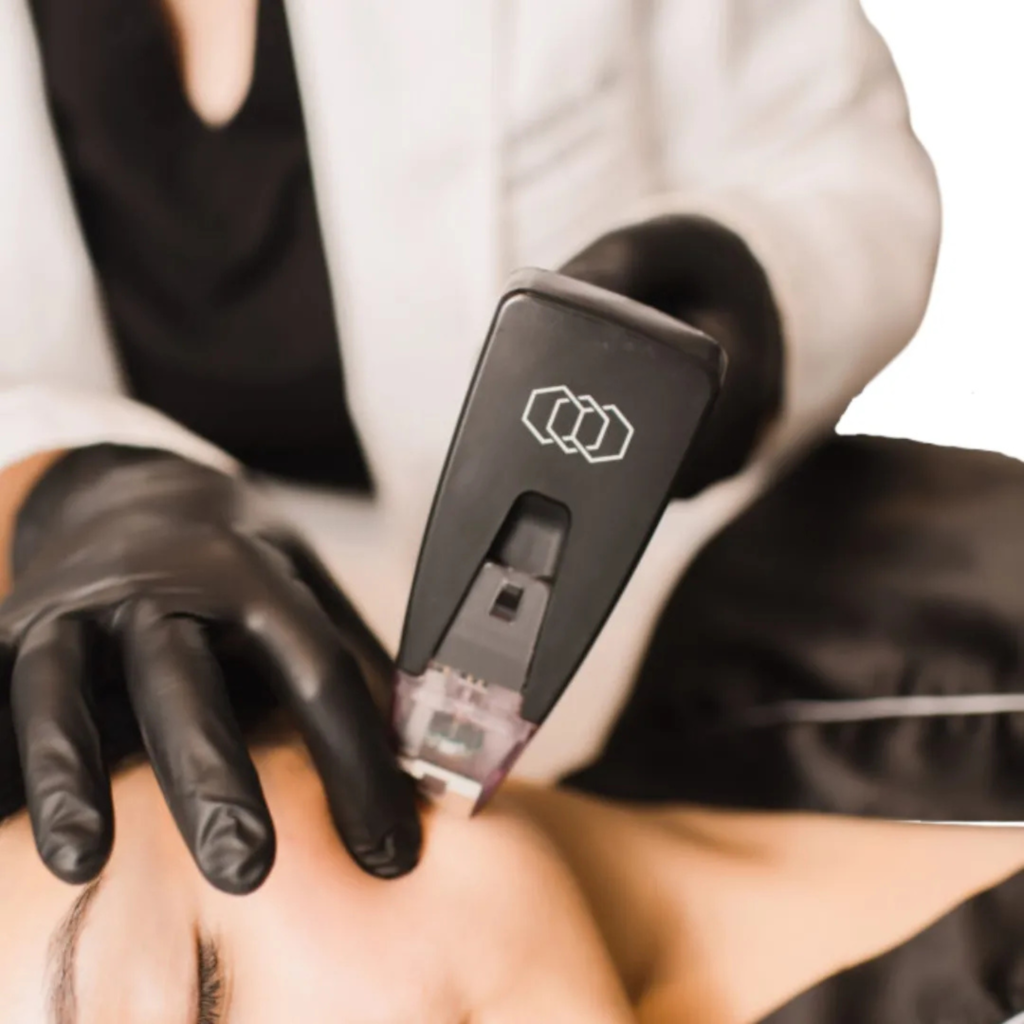 Intradermoterapia Capilar