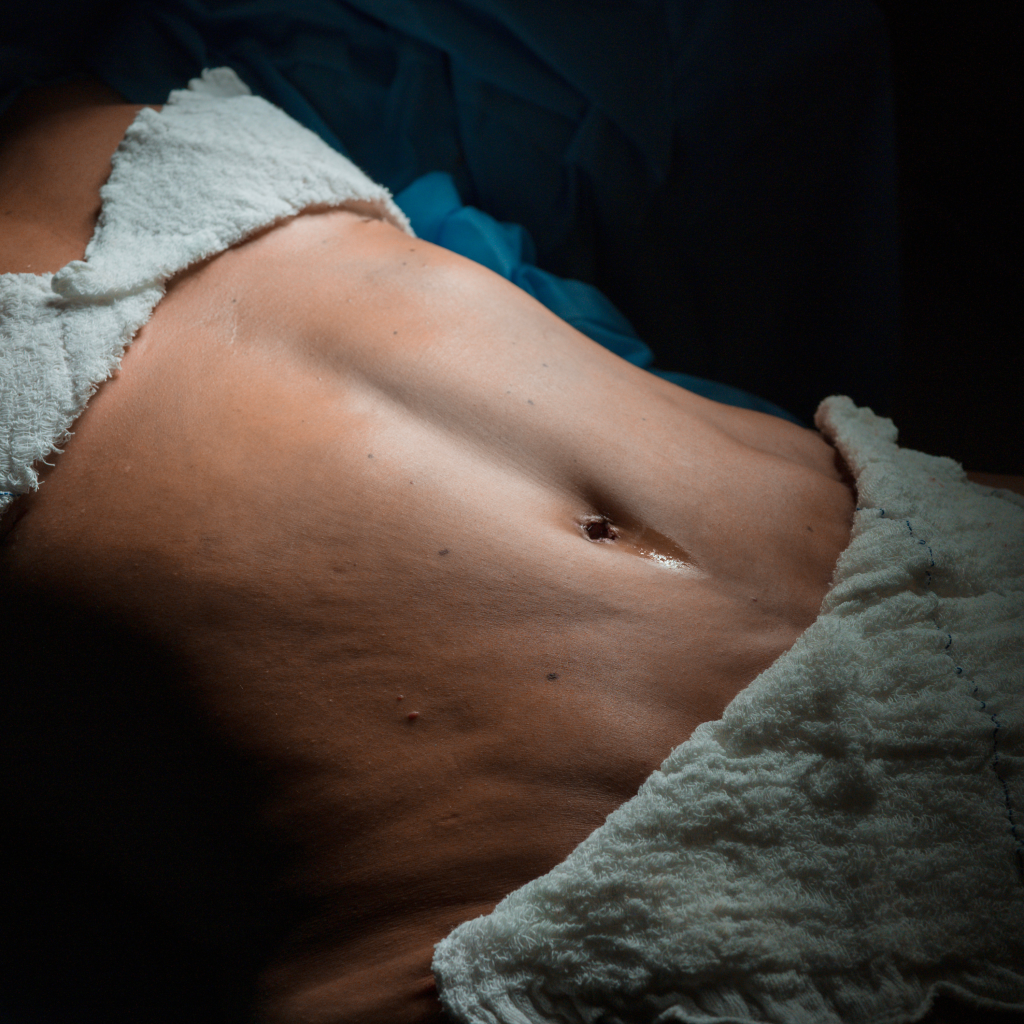 Abdominoplastia